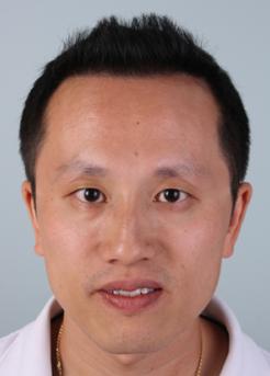 After Hair Transplant&nbsp;Front